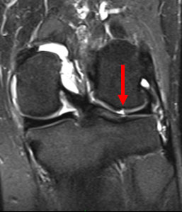 Figure 1: MRI showing a full thickness cartilage defect of the lateral femoral condyle