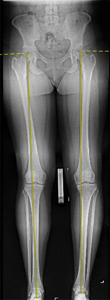 Figure 8: Full length alignment x-rays with weight bearing axis drawn