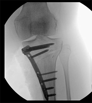 Figure 9: X-ray after High tibial osteotomy with plate and screws in place