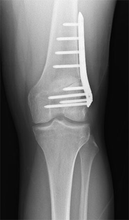 Figure 10: X-ray after distal femur osteotomy with plate and screws in place