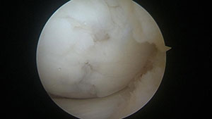 Figure 2: Arthroscopic image of a lateral femoral condyle cartilage defect