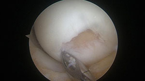 Figure 3: Arthroscopic image after debridement of cartilage defect