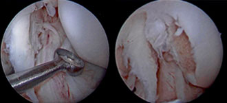 Figures 4 and 5: Arthroscopic image of taking a cartilage biopsy from the lateral femoral condyle