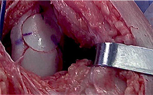 Figure 7: Osteochondral allograft two plug “snowman” technique