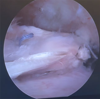 Figure 2: Arthroscopic image of biceps autograft patch being inserted