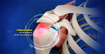 Figure 3: Subacromial impingement with bursitis, or inflammation of the bursa overlying the rotator cuff tendons