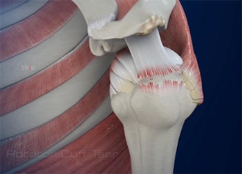 Figure 4: Full thickness rotator cuff tear of the supraspinatus tendon.